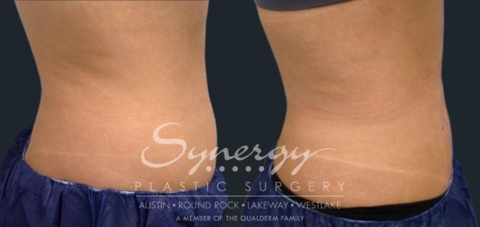 coolsculpting treatment