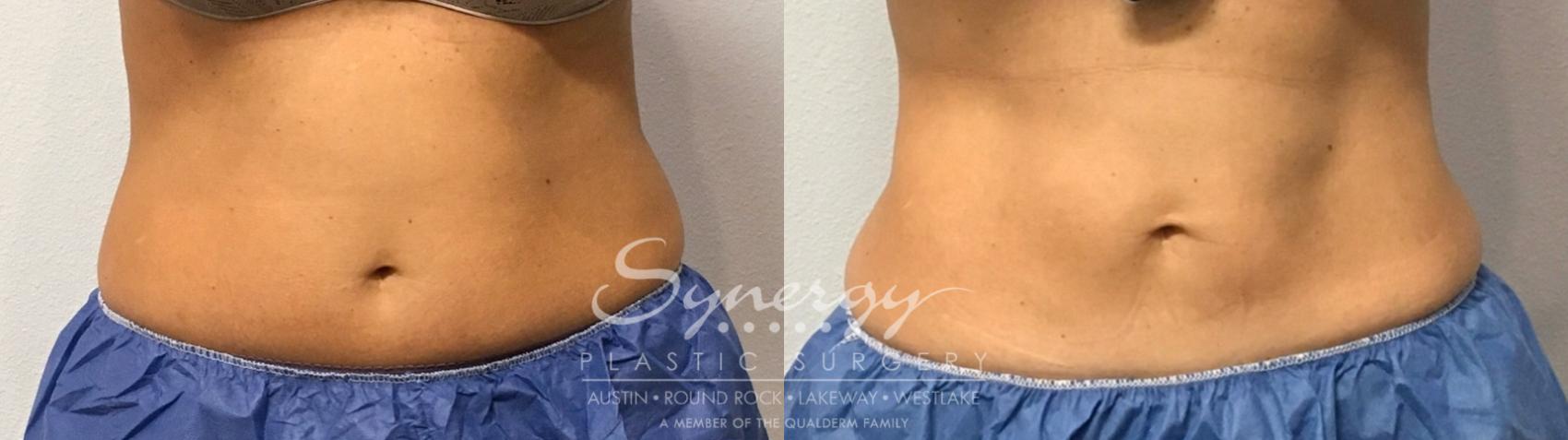 Before & After CoolSculpting® Case 854 Front View in Austin, TX