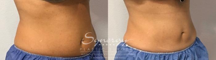 Before & After CoolSculpting® Case 854 Left Oblique View in Austin, TX