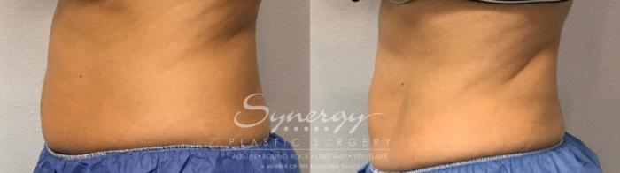 Before & After CoolSculpting® Case 854 Right Side View in Austin, TX