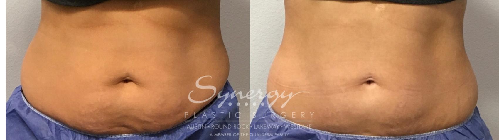 Before & After CoolSculpting® Case 856 Front View in Austin, TX