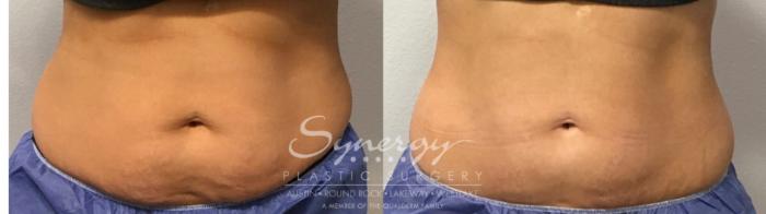 Before & After CoolSculpting® Case 856 Front View in Austin, TX