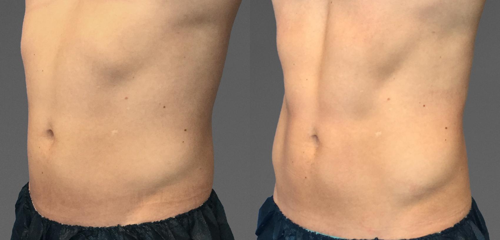 Before & After CoolTone® Case 778 View #1 View in Austin, TX