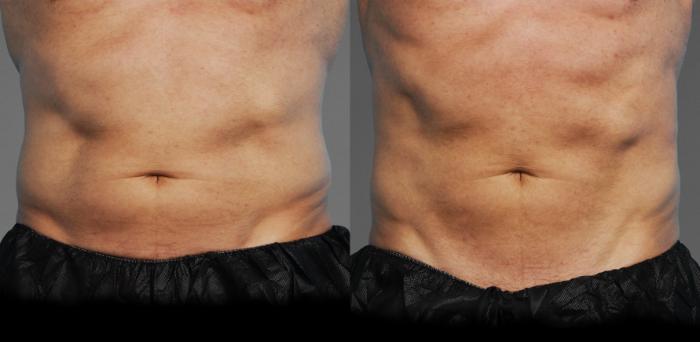 Before & After CoolTone® Case 779 View #1 View in Austin, TX