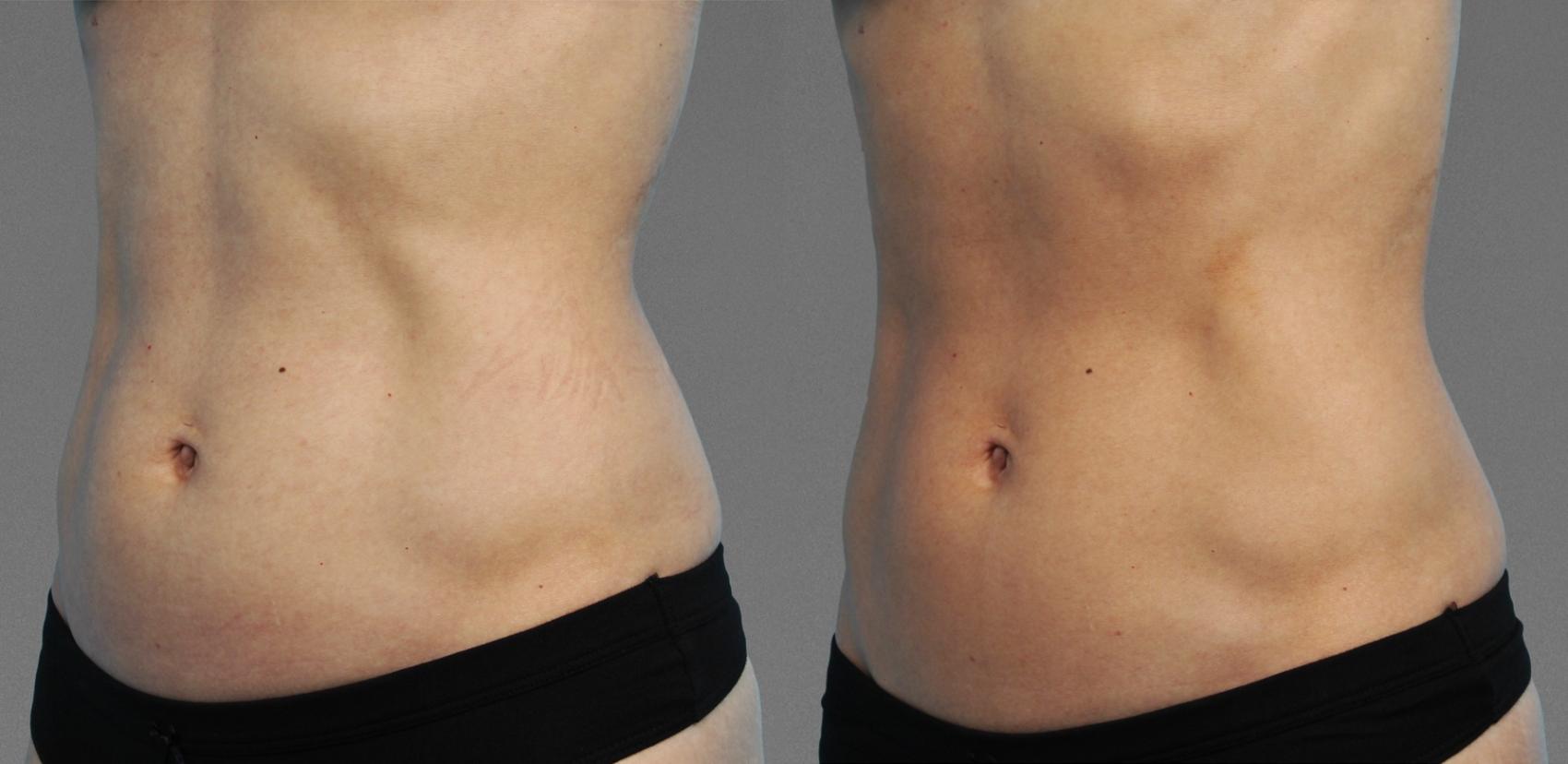 Before & After  Case 780 View #1 View in Austin, TX