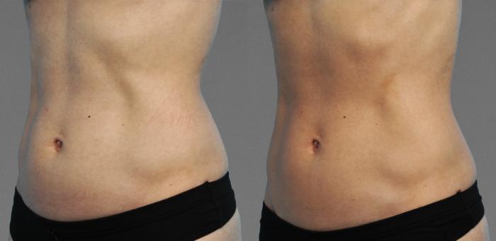 Before & After CoolTone® Case 780 View #1 View in Austin, TX