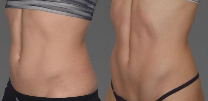 Before & After CoolTone® Case 781 View #1 View in Austin, TX