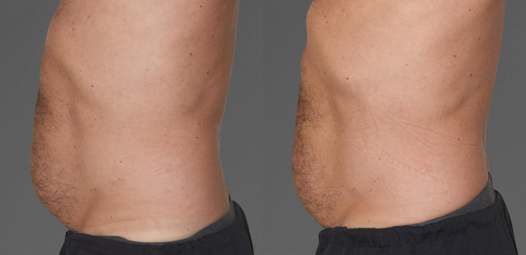 Before & After  Case 782 View #1 View in Austin, TX