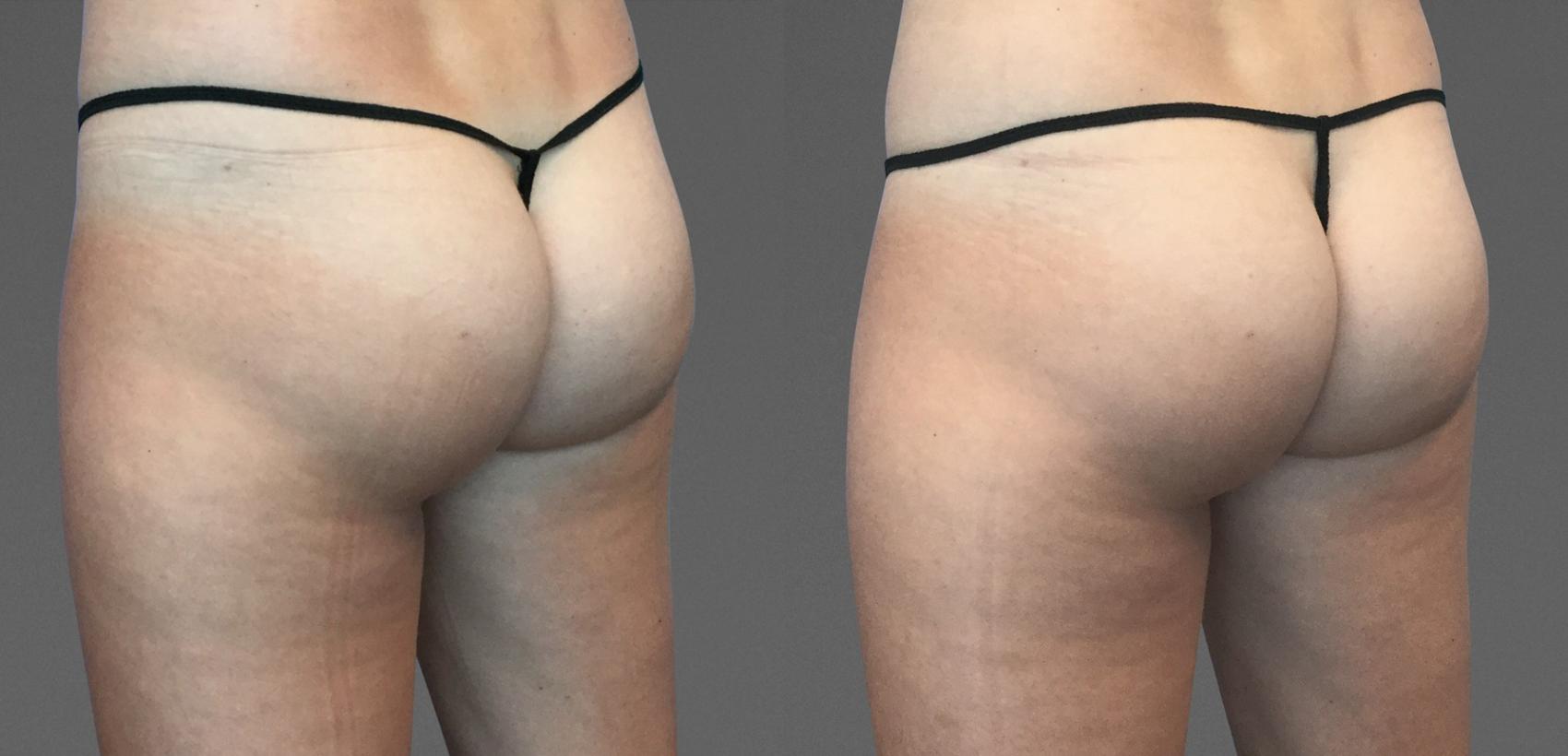 Before & After  Case 783 View #1 View in Austin, TX