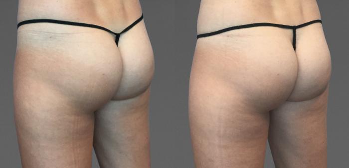 Before & After CoolTone® Case 783 View #1 View in Austin, TX