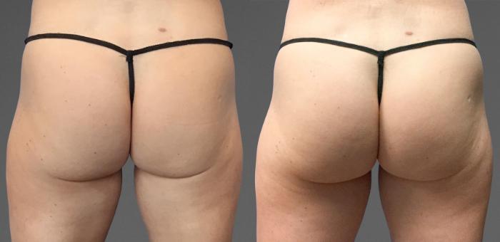 Before & After CoolTone® Case 784 View #1 View in Austin, TX