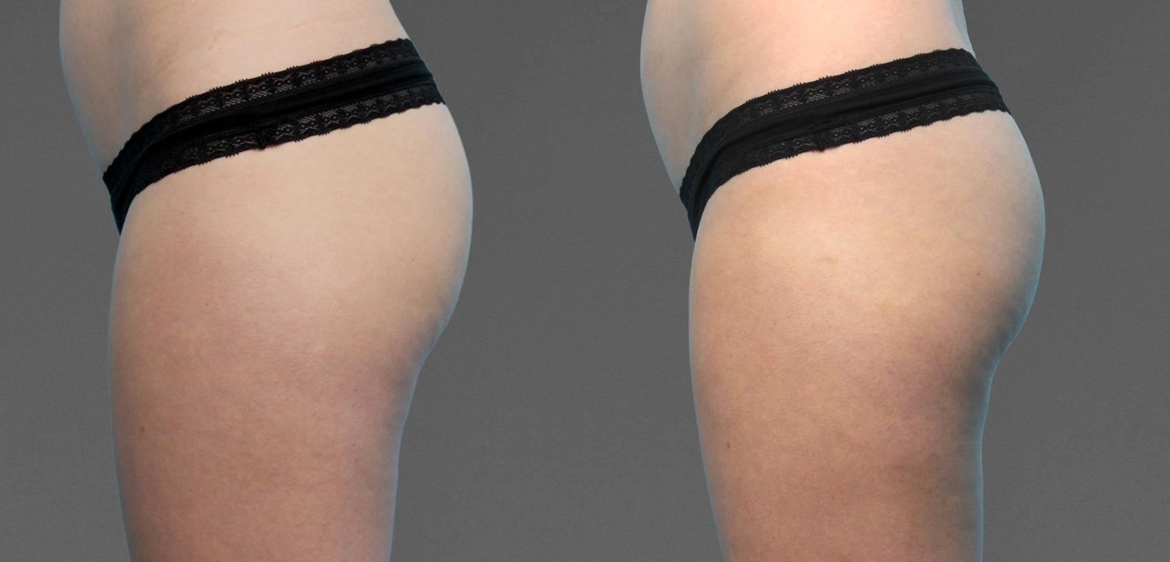 Before & After  Case 785 View #1 View in Austin, TX