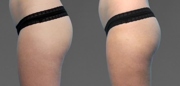 Before & After CoolTone® Case 785 View #1 View in Austin, TX