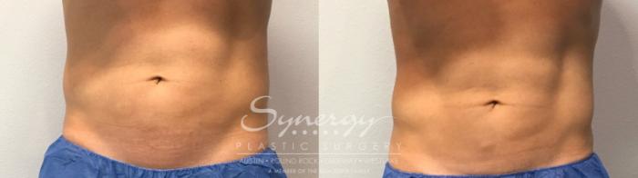 Before & After CoolTone® Case 855 Front View in Austin, TX