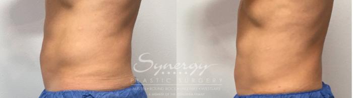 Before & After CoolTone® Case 855 Right Side View in Austin, TX