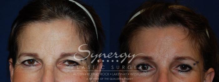 Before & After  Case 122 View #1 View in Austin, TX