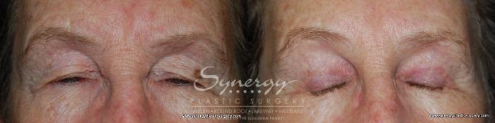 Before & After  Case 145 View #2 View in Austin, TX