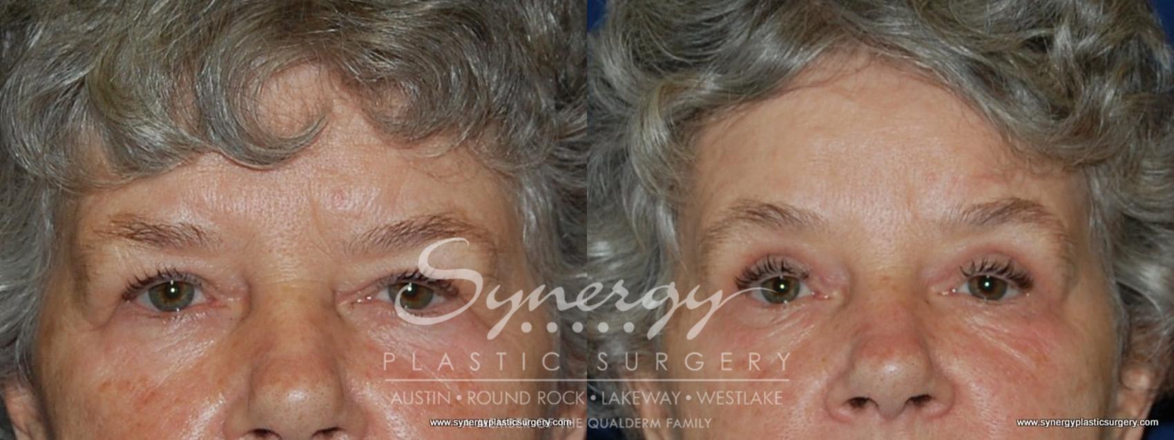 Before & After  Case 183 View #1 View in Austin, TX