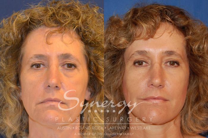 Before & After Endoscopic Brow Lift/Upper Eyelid Surgery Case 303 View #1 View in Austin, TX