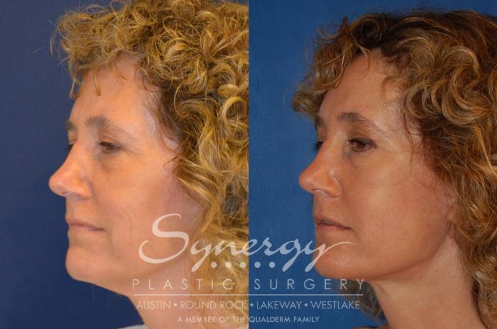 Before & After  Case 303 View #5 View in Austin, TX