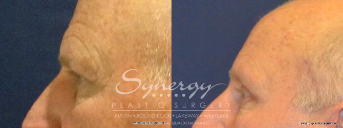 Before & After  Case 345 View #4 View in Austin, TX