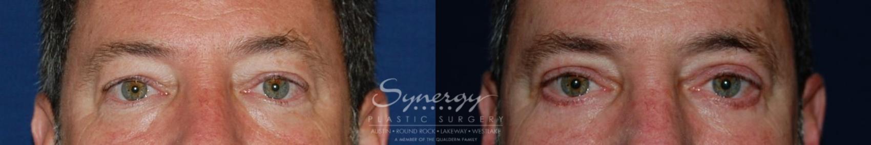 Before & After Eyelid Surgery (Blepharoplasty) Case 126 View #1 View in Austin, TX
