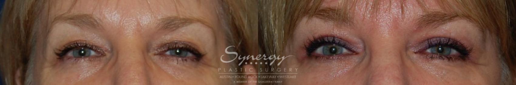 Before & After Eyelid Surgery (Blepharoplasty) Case 130 View #1 View in Austin, TX