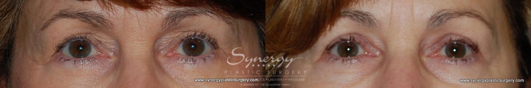 Before & After Eyelid Surgery (Blepharoplasty) Case 167 View #1 View in Austin, TX