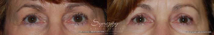 Before & After Eyelid Surgery (Blepharoplasty) Case 167 View #1 View in Austin, TX