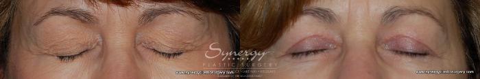 Before & After Eyelid Surgery (Blepharoplasty) Case 167 View #2 View in Austin, TX