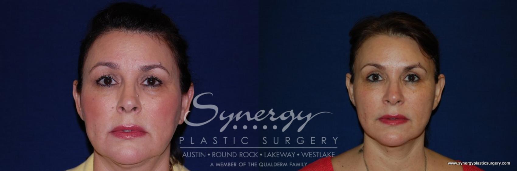 Before & After Eyelid Surgery (Blepharoplasty) Case 193 View #1 View in Austin, TX