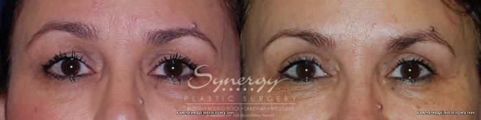 Before & After Eyelid Surgery (Blepharoplasty) Case 193 View #4 View in Austin, TX