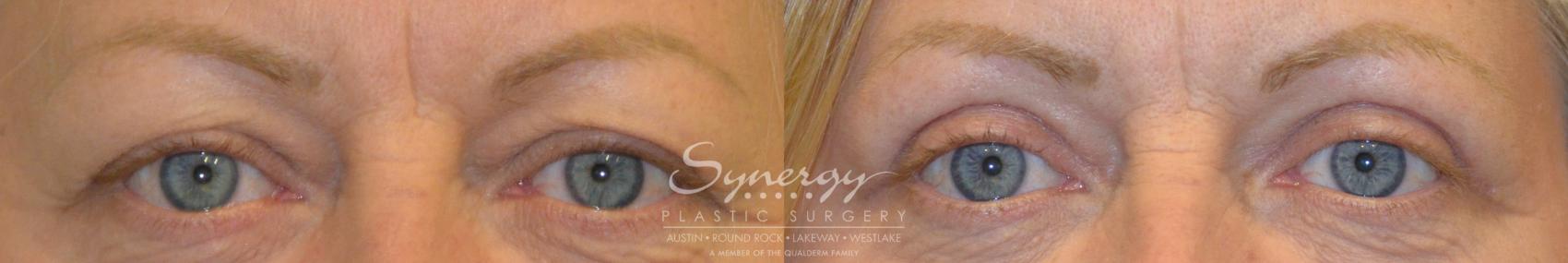 Before & After Eyelid Surgery (Blepharoplasty) Case 202 View #1 View in Austin, TX