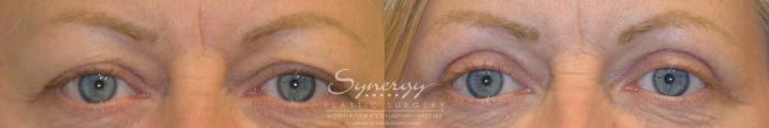 Before & After Eyelid Surgery (Blepharoplasty) Case 202 View #1 View in Austin, TX