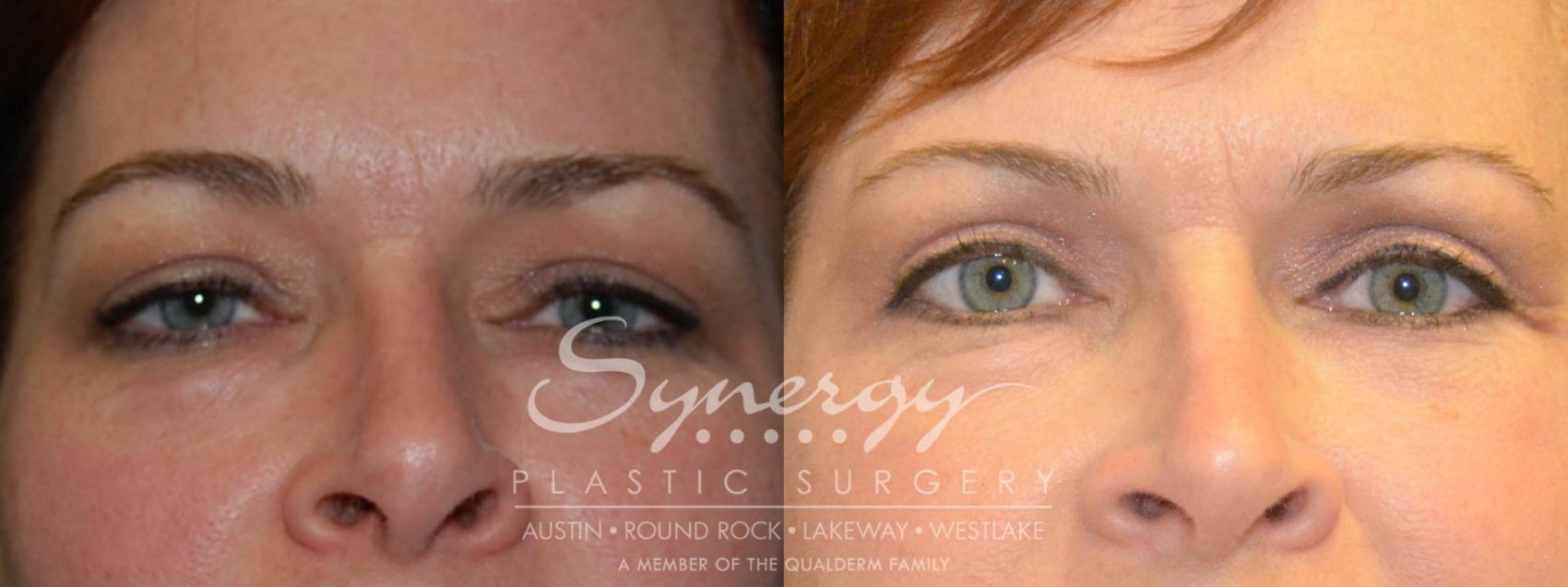Before & After Eyelid Surgery (Blepharoplasty) Case 206 View #1 View in Austin, TX