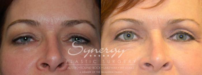 Before & After Eyelid Surgery (Blepharoplasty) Case 206 View #1 View in Austin, TX