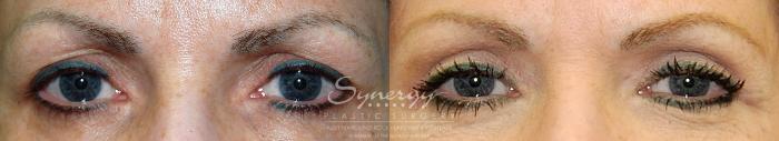 Before & After Eyelid Surgery (Blepharoplasty) Case 25 View #1 View in Austin, TX
