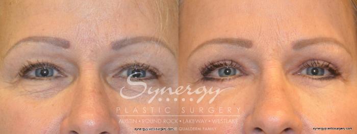 Before & After  Case 273 View #1 View in Austin, TX