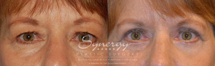 Before & After Eyelid Surgery (Blepharoplasty) Case 309 View #1 View in Austin, TX