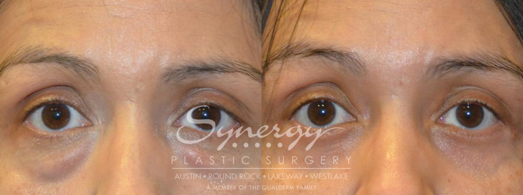 Before & After Eyelid Surgery (Blepharoplasty) Case 382 View #1 View in Austin, TX