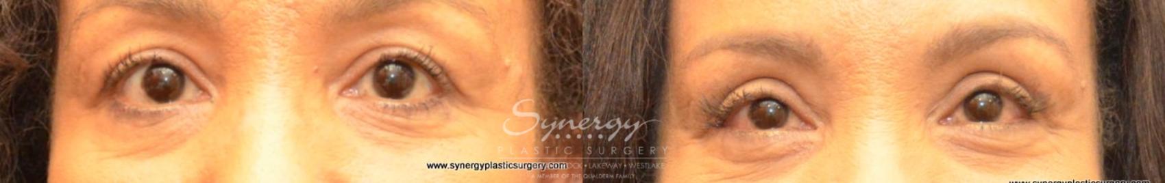 Before & After Eyelid Surgery (Blepharoplasty) Case 483 View #1 View in Austin, TX