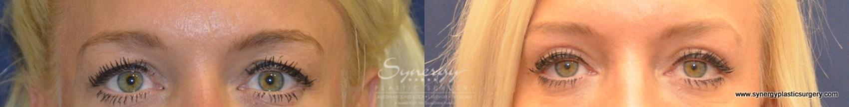 Before & After Eyelid Surgery (Blepharoplasty) Case 487 View #1 View in Austin, TX