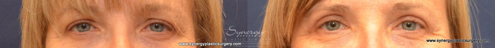 Before & After  Case 574 View #1 View in Austin, TX