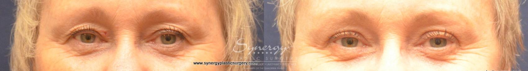 Before & After Eyelid Surgery (Blepharoplasty) Case 687 View #1 View in Austin, TX