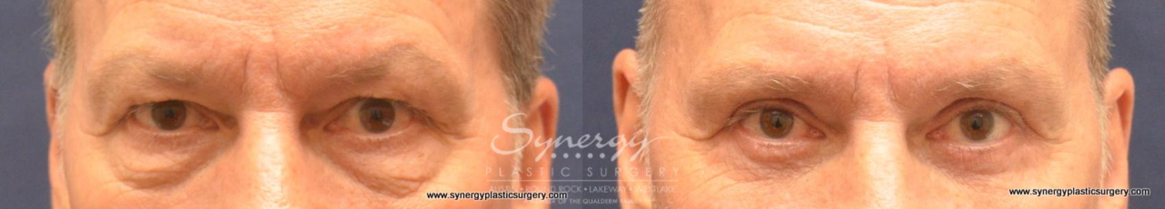 Before & After Eyelid Surgery (Blepharoplasty) Case 724 View #1 View in Austin, TX