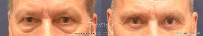 Before & After Eyelid Surgery (Blepharoplasty) Case 724 View #1 View in Austin, TX