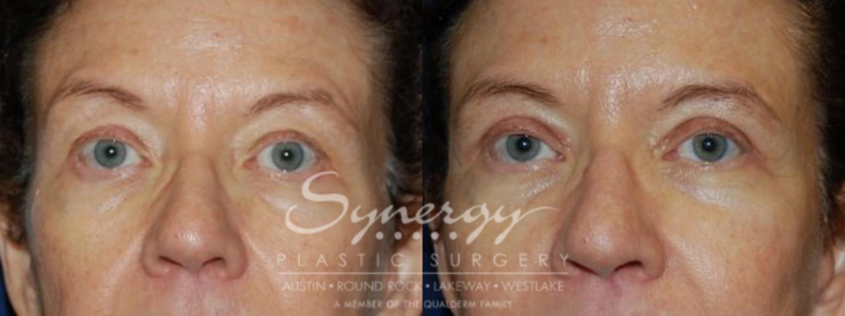 Before & After  Case 75 View #1 View in Austin, TX