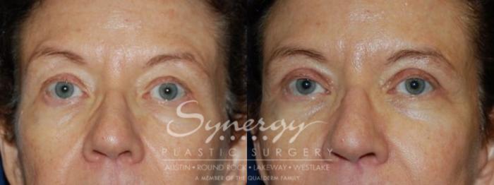 Before & After  Case 75 View #1 View in Austin, TX