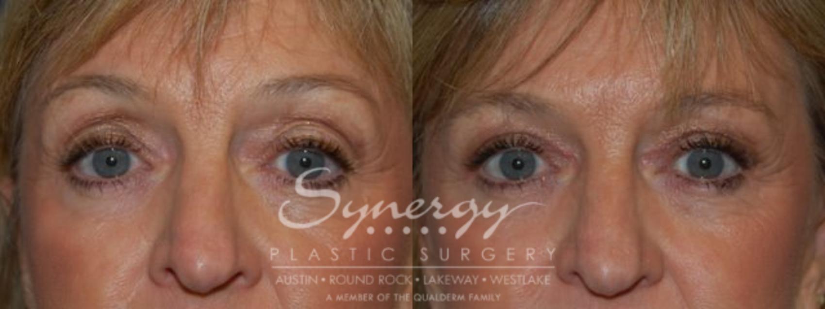 Before & After Eyelid Surgery (Blepharoplasty) Case 79 View #1 View in Austin, TX