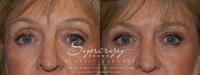 Before & After Eyelid Surgery (Blepharoplasty) Case 79 View #1 View in Austin, TX